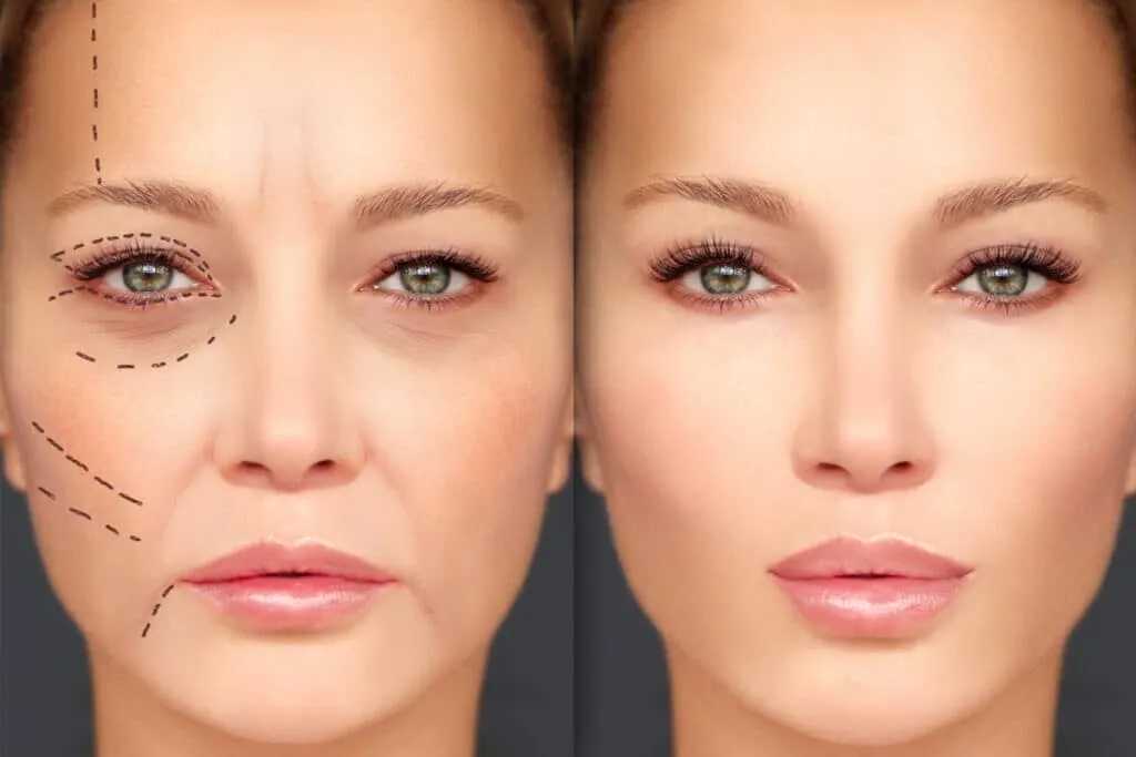 Lip Enhancement