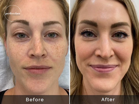 Under-Eye Brightening