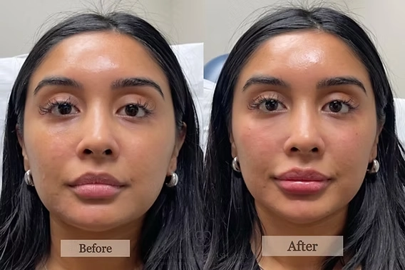 Under-Eye Rejuvenation