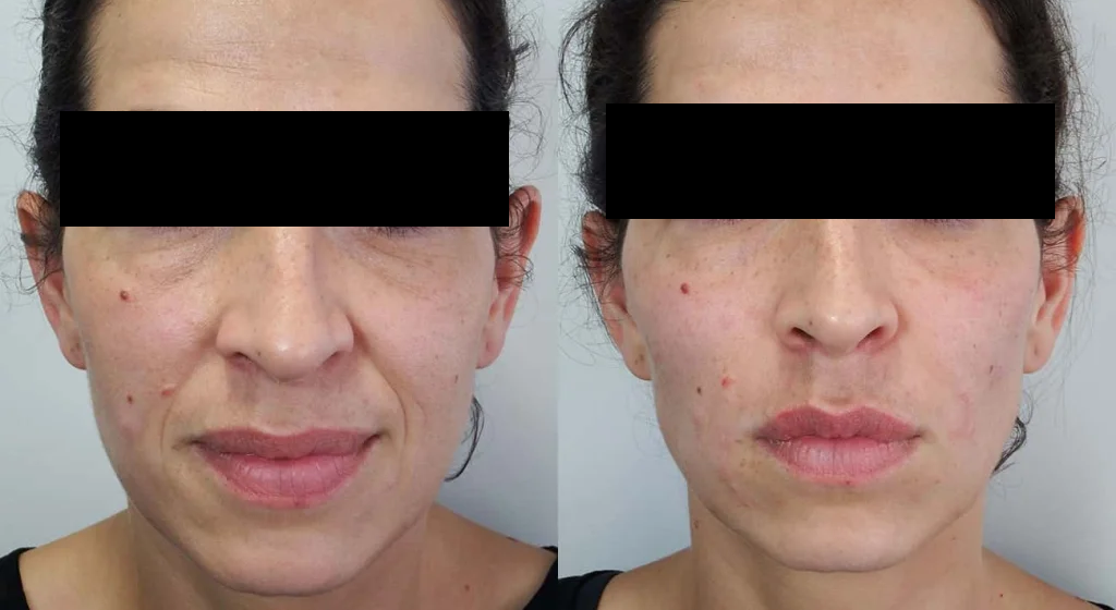 Facial Contouring