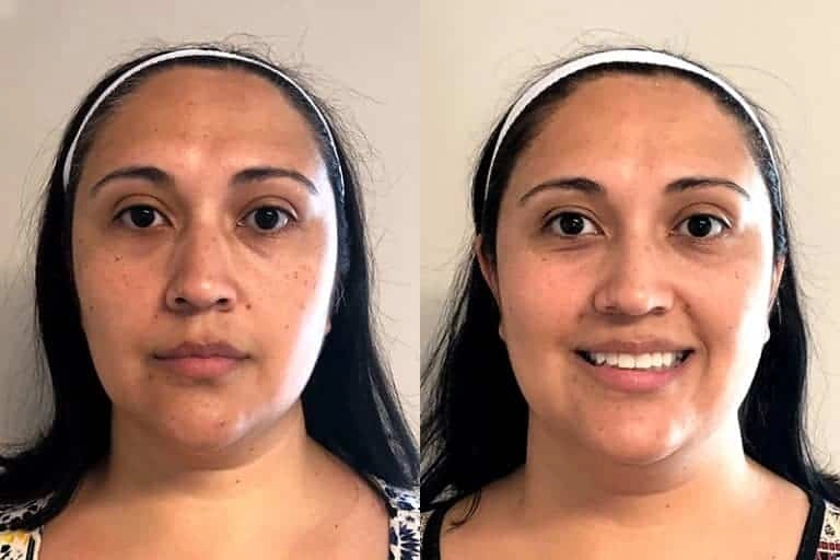 Rejuvenated Skin